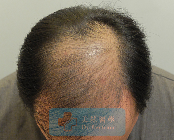 Pre-procedure