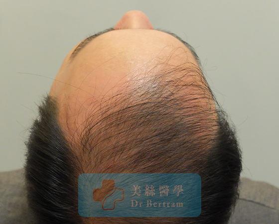 Pre-procedure