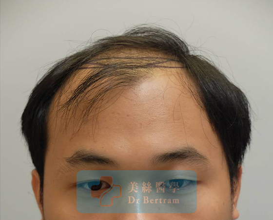 Before: Class IVa frontal recession