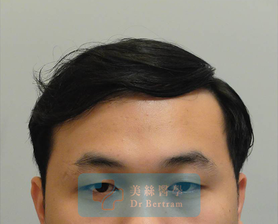 After 12 months: Restored hairline