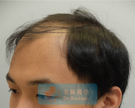 Before: Mid-scalp thinning visible