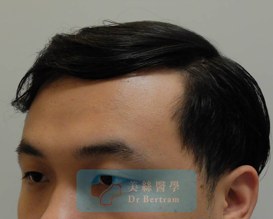 After: Improved coverage