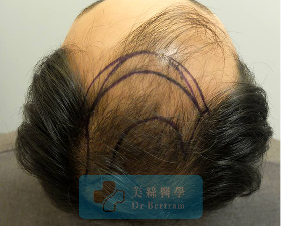 Before: Side temporal recession