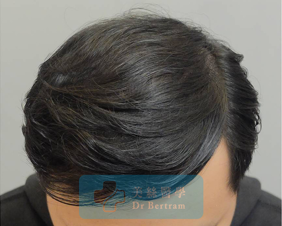 After: Natural density
