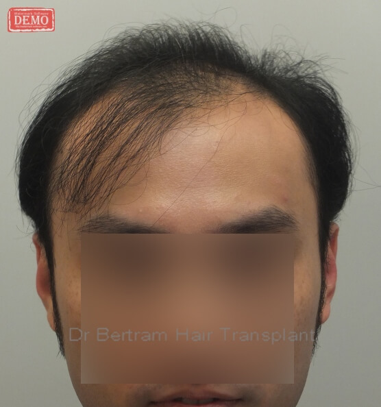 Before: Frontal view, Class V pattern