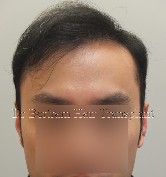 12 months post-procedure: Frontal view
