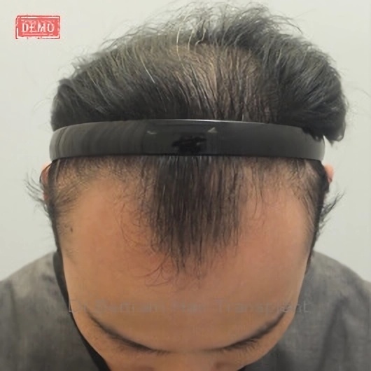 Before: Side view, temporal recession