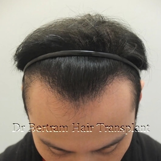 12 months post-procedure: Side view