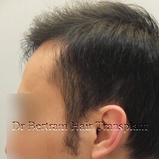 12 months post-procedure: Rear angle