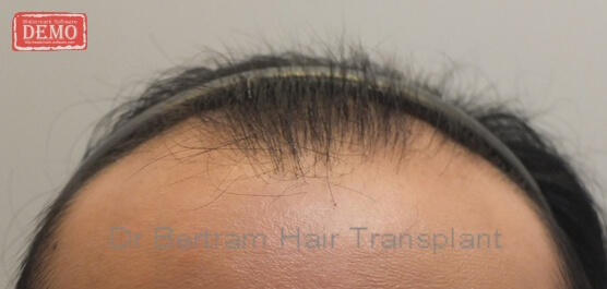 Before: Top view, crown thinning