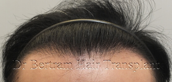 12 months post-procedure: Top view