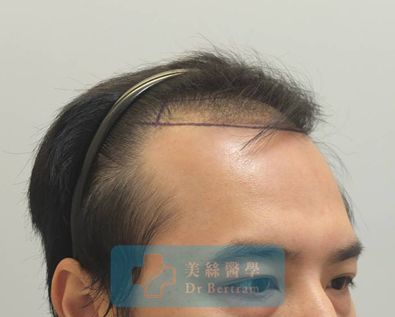 Pre-procedure: Temporal recession