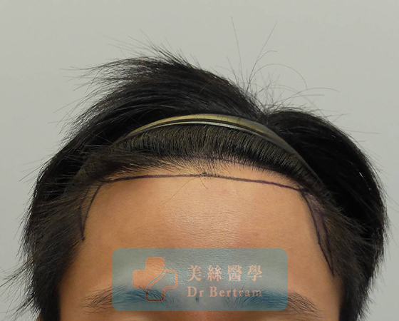 Before: Class IIIa frontal recession