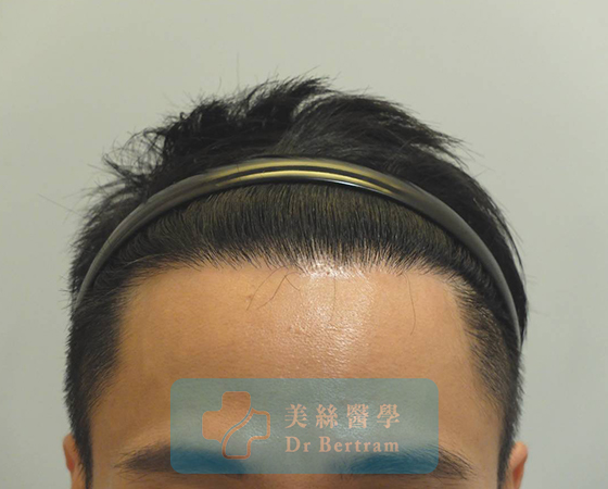 After 12 months: Restored hairline