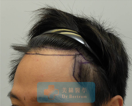 Before: Mid-scalp, stable crown