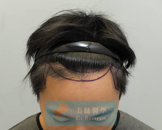 Before: Side temporal recession