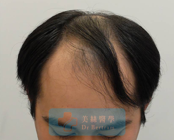 Before: Class IVa frontal recession