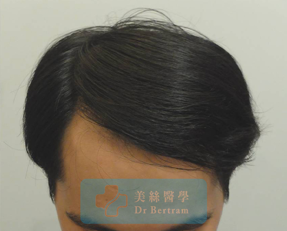 After 12 months: Restored hairline