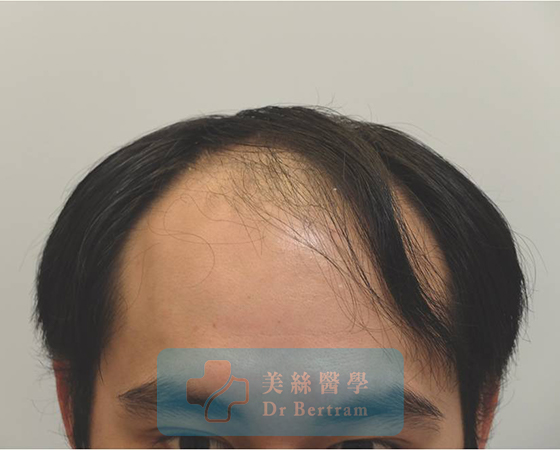 Before: Mid-scalp thinning visible