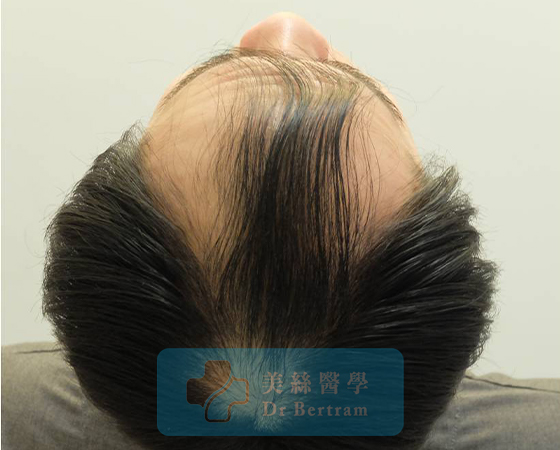 Before: Side temporal recession