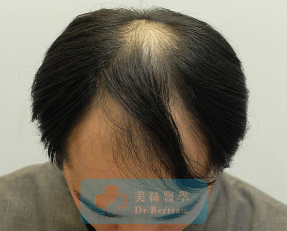 Before: Fine hair characteristics close-up