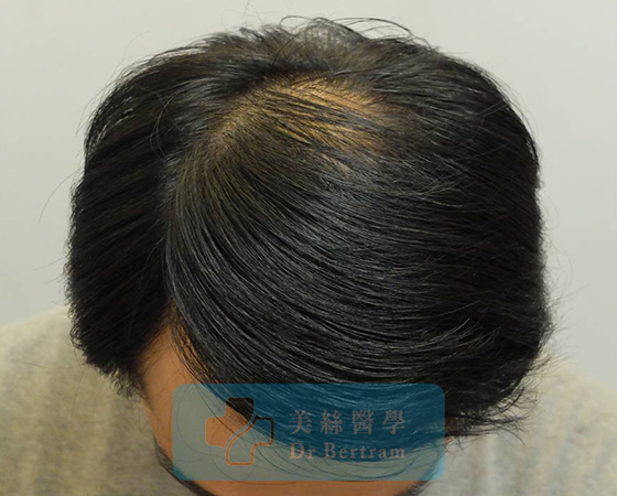After: Natural density