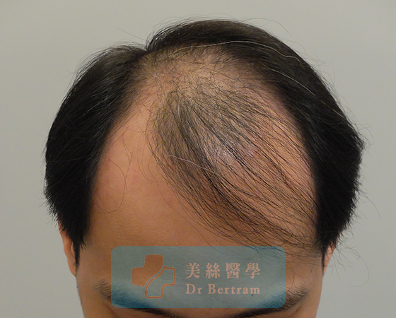 Before: Class IVa frontal recession