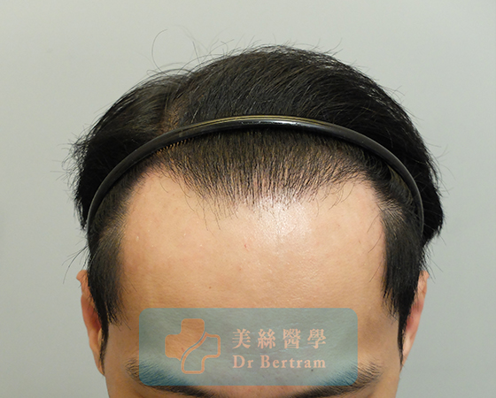 After 12 months: Restored hairline