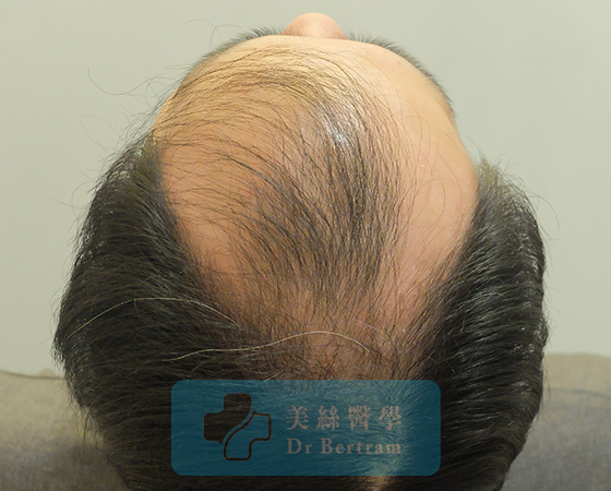 Before: Mid-scalp thinning visible