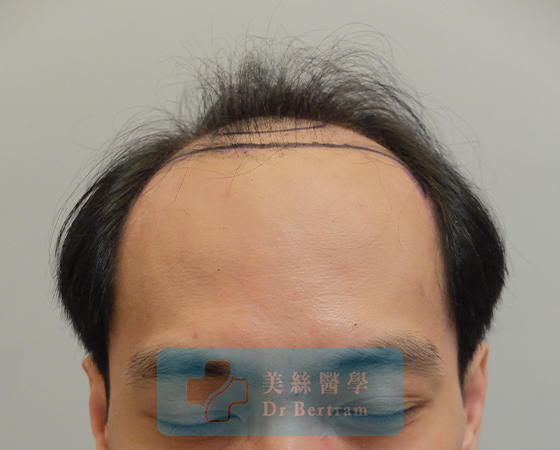 Before: Side temporal recession