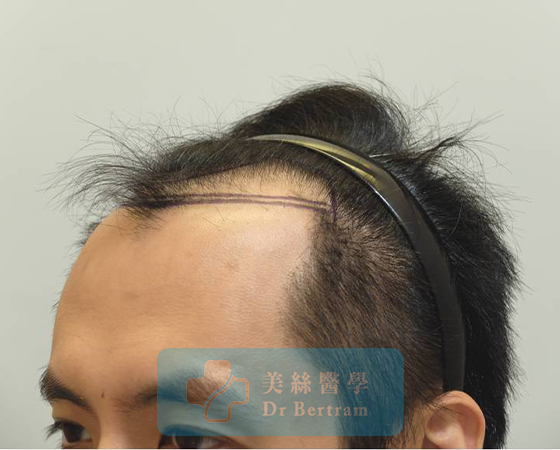 Before: Class IIIa frontal recession