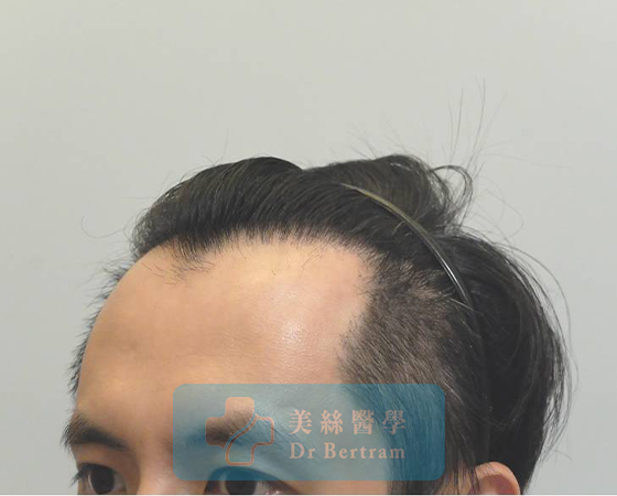 After 12 months: Restored hairline
