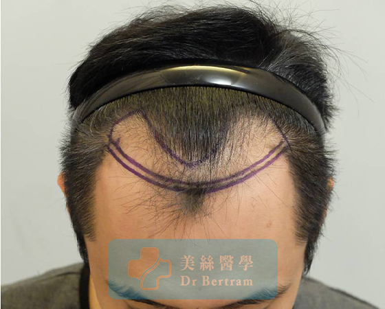 Before: Mid-scalp, stable crown