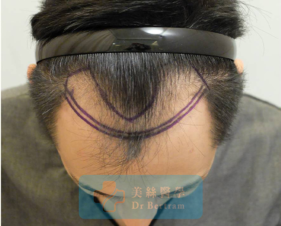 Before: Side temporal recession