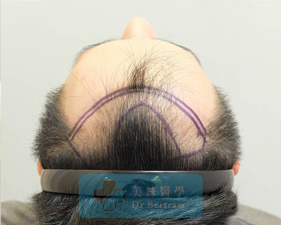 Before: Fine hair characteristics close-up