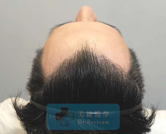 After: Natural density