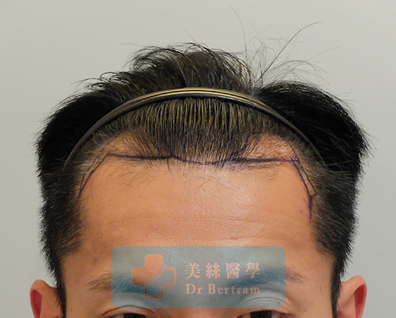 Before: Class III frontal recession