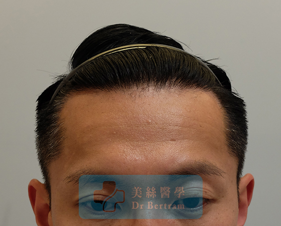 After 12 months: Restored hairline