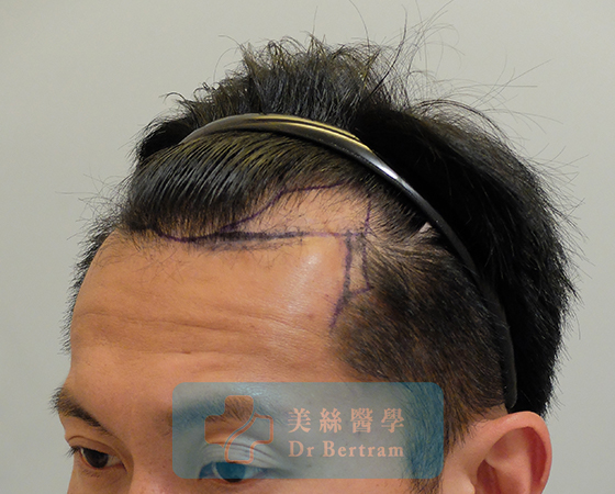 Before: Mid-scalp, stable crown