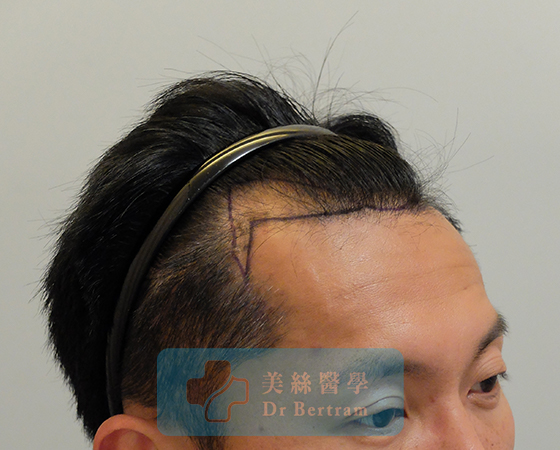 Before: Side temporal recession
