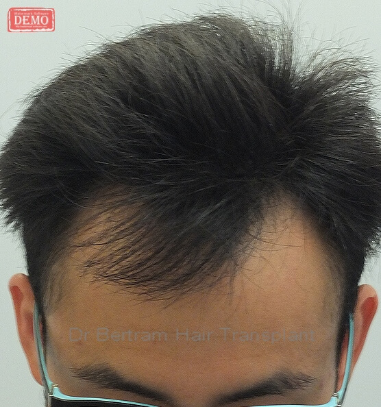 Before: Frontal view, Class V pattern