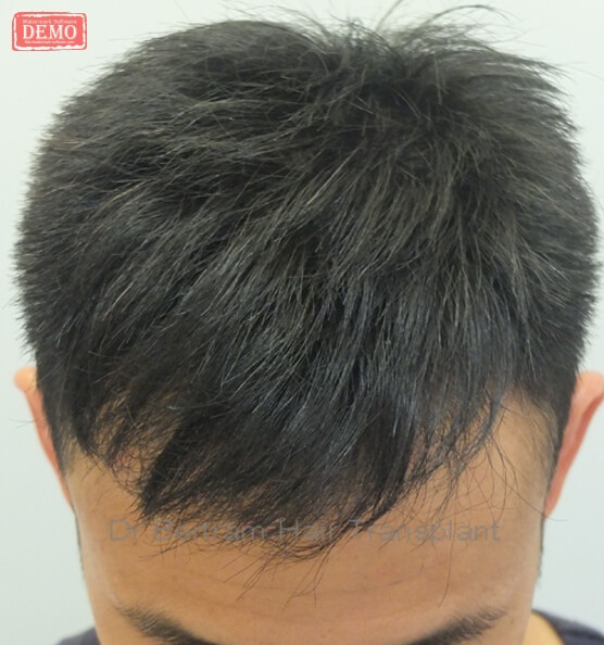 12 months post-procedure: Frontal view