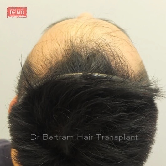 12 months post-procedure: Side view