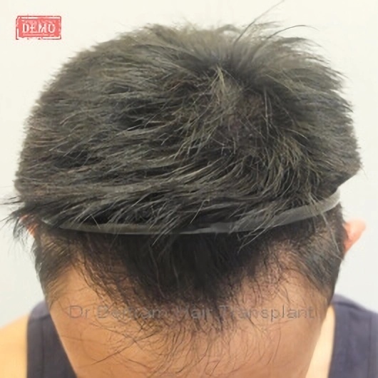 12 months post-procedure: Rear angle
