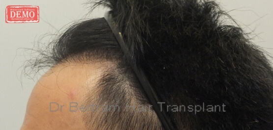 12 months post-procedure: Top view