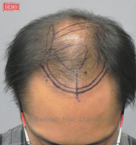 術前：正面角度