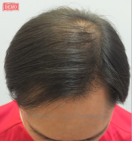 術後12個月：髮際線效果