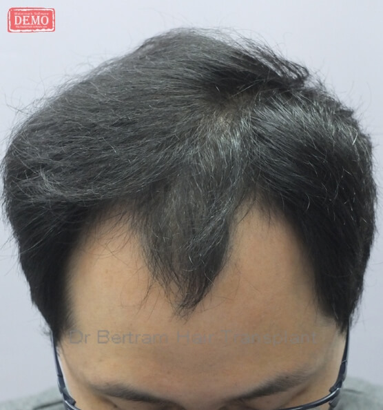 Before: Frontal view, Class V pattern