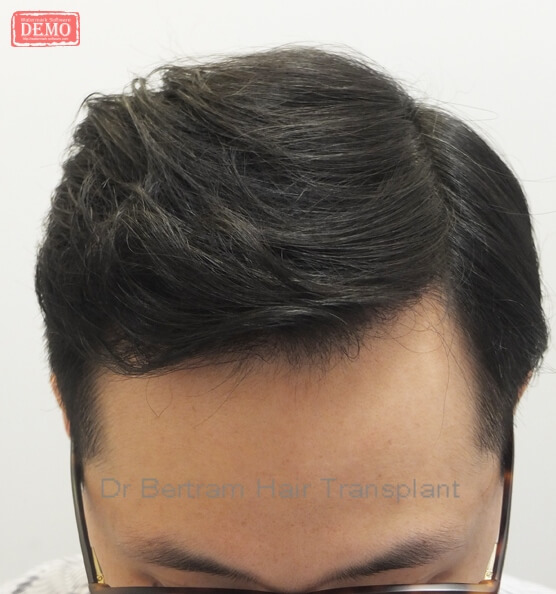 12 months post-procedure: Frontal view