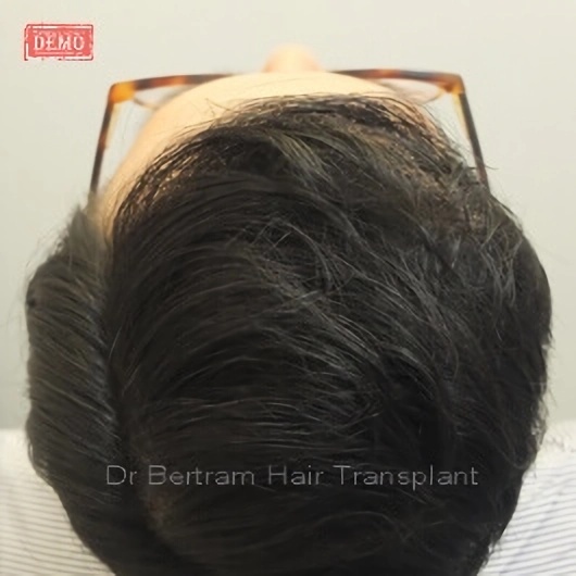 12 months post-procedure: Side view